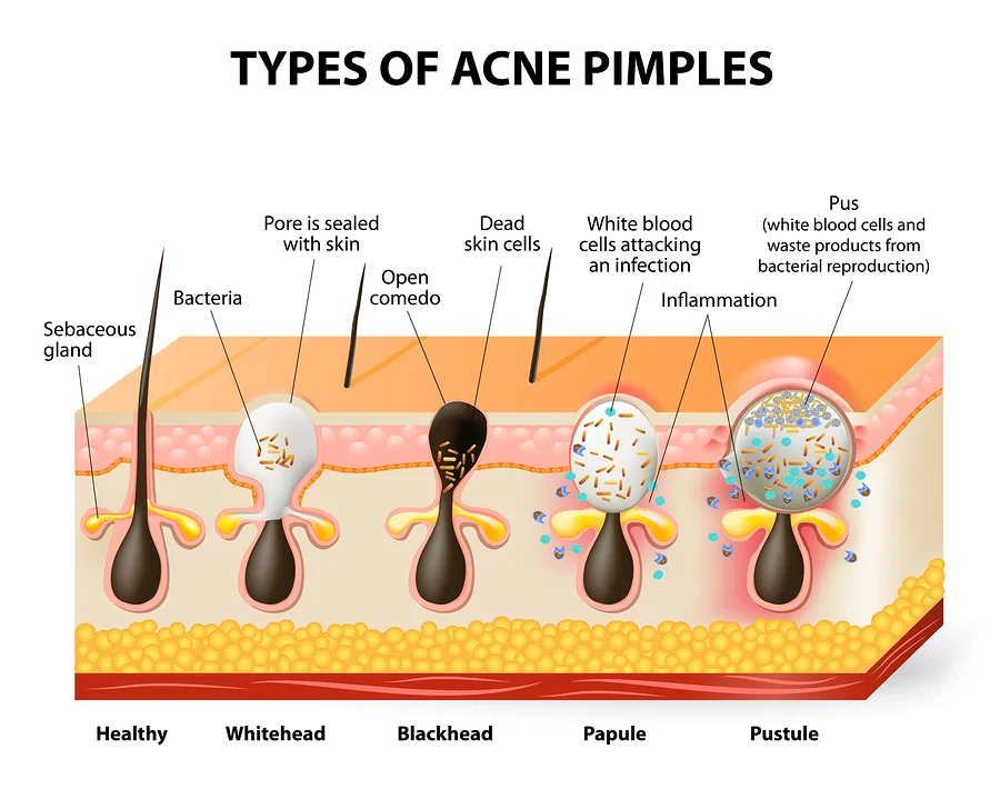 Acne treatment program at Raah Acupuncture, Koreatown Los Angeles