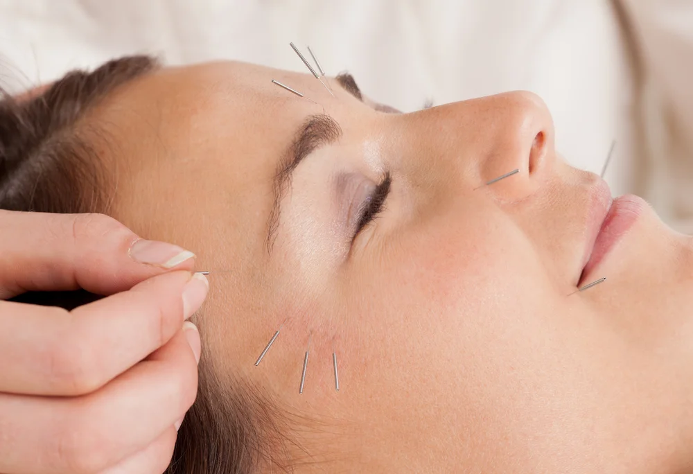 Facial acupuncture at Raah Acupuncture, Koreatown Los Angeles