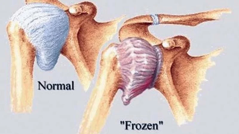 frozen shoulder.jpg