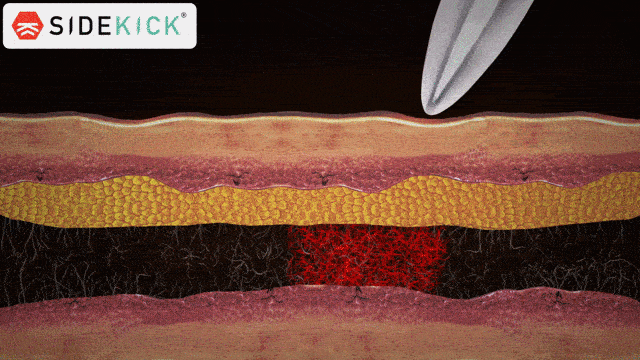 scraping-small-opimazed+(1).gif