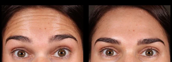 Before and after anti-wrinkle injections for forehead lines. Treatment performed by Mike Clague Aeshetic nurse. *All results shown on our website have been achieved by our team members. Please note that results are individual and may vary.