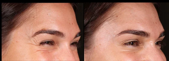 Before and after anti-wrinkle injections for crows feet. Treatment performed by Mike Clague Aeshetic nurse. *All results shown on our website have been achieved by our team members. Please note that results are individual and may vary.