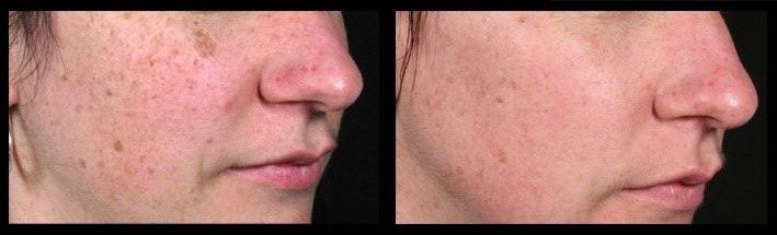 Fraxel Dual for sun spots & pigmentation
