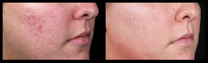 Fraxel Dual for acne scarring