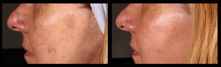 Fraxel Dual for sun spots and pigmentation