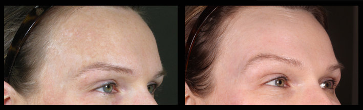 Fraxel Dual for pigmentation