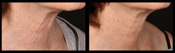 Venus Viva for neck wrinkles and tightening