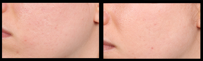 Venus Viva for mild acne scarring