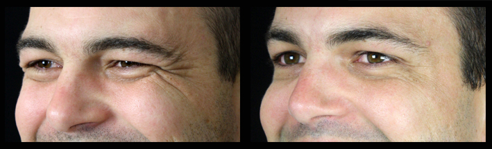 Muscle Relaxing Injections for crow's feet