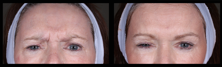 Muscle Relaxing Injections for frown lines