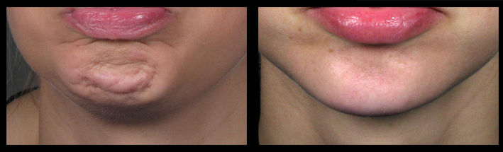 Muscle Relaxing Injections for popply chin