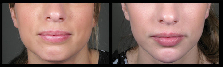 Muscle Relaxing Injections and Dermal Fillers for lower face sculpting