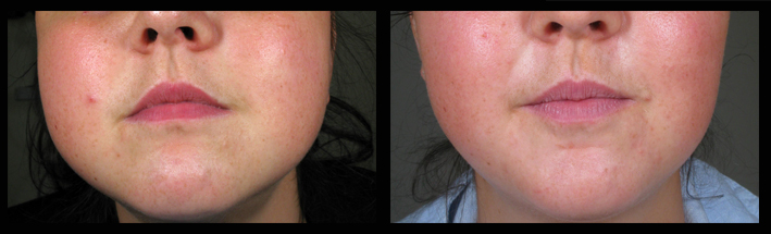 Muscle Relazing Injections for excessive squareness of the face and teeth grinding