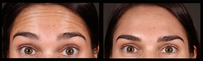 Muscle Relaxing Injections for forehead lines