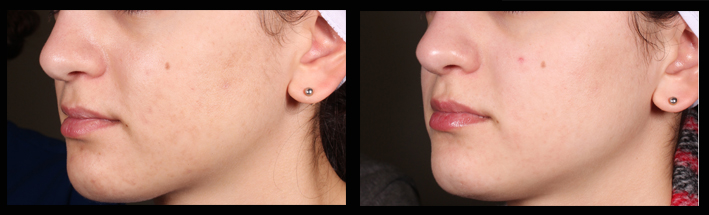 IPL for mild pigmentation