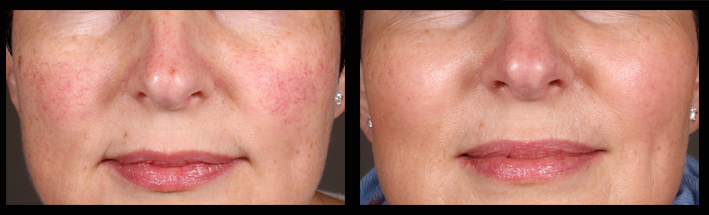 Vascular Laser for blood vessels
