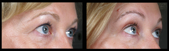 Blepharoplasty (Upper Eyelid Surgery)