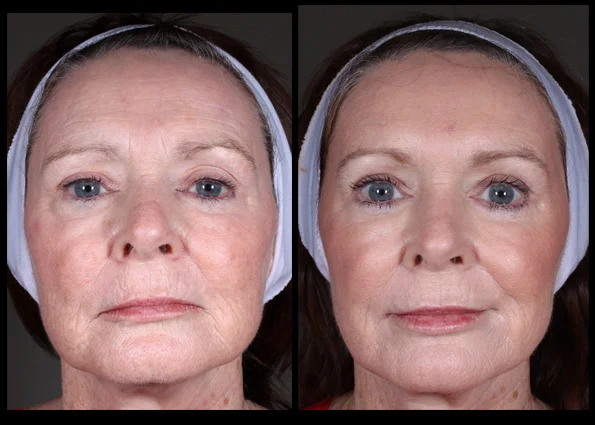 Dermal Fillers and Muscle Relaxant Injections for facial contouring, shaping and rejuvenation. Treatment performed by Assoc Prof Greg Goodman *