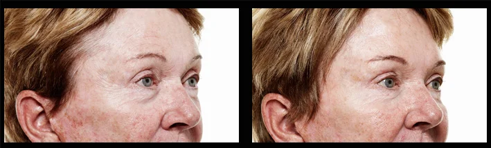 Dermal Filler for upper face rejuvenation