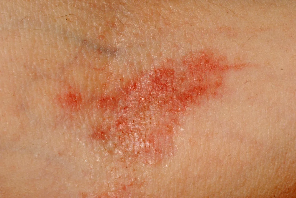 Example of Atopic eczema in the elbow crease