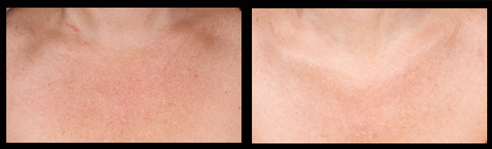 Intense Pulsed Light Ipl At The Dermatology Institute Of Victoria