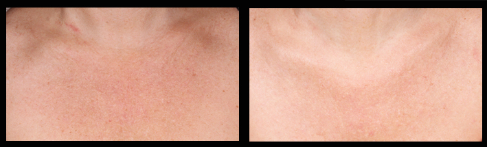 IPL for chest sun damage