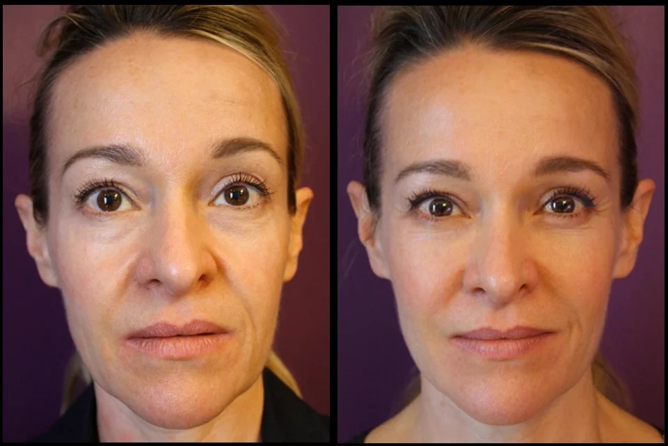 Full facial rejuvenation by Mike Clague (Aesthetic Nurse)