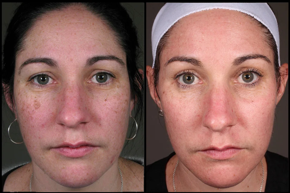 Treatment of pigmentation by Melissa Daniell (RN)