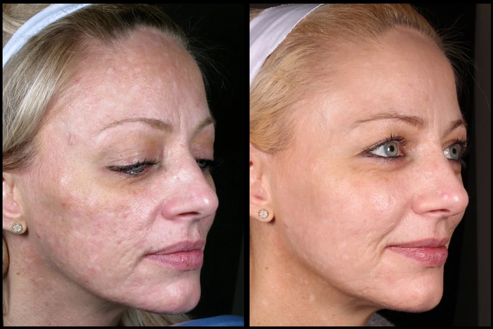 Treatment of Acne Scarring by Assoc Prof Greg Goodman, Kristin Campbell (RN), Tara Coetzer (RN)