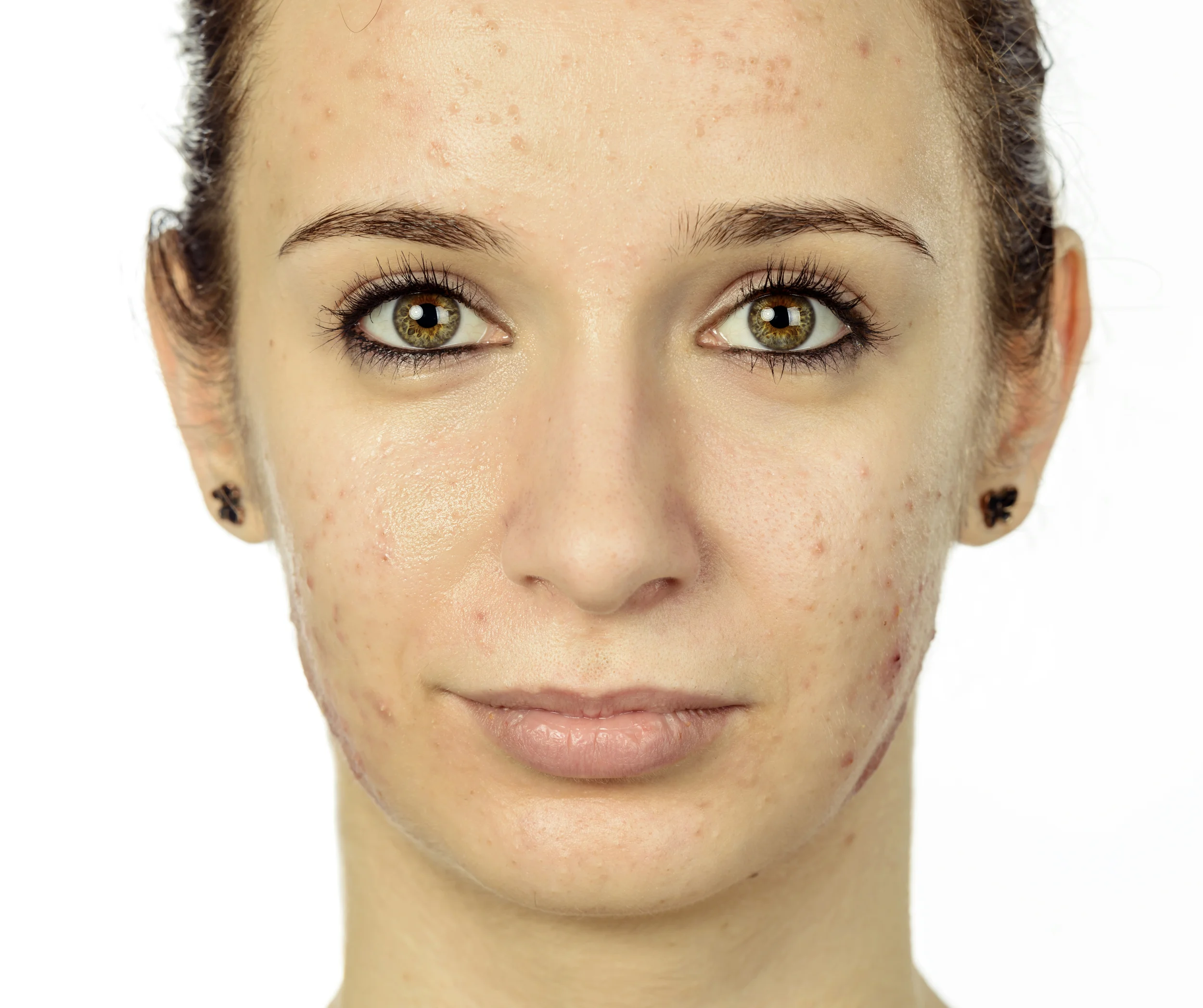 Acne sunscreen picture.jpg