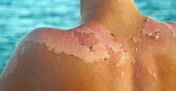 There is no excuse for not wearing sunscreen