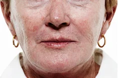 Before dermal filler treatment with Dr Stefania Roberts