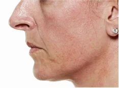 Before dermal filler treatment with Dr Stefania Roberts
