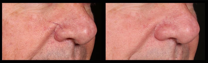 Blood vessel on the nose treated by Assoc Prof Greg Goodman with a vascular laser .