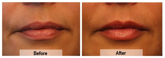 Lip enhancement performed by Mike Clague Aesthetic Nurse