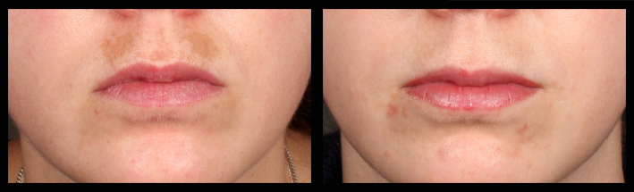 Upper lip pigmentation before treatment with the Q Switched YAG laser at DIV and after treatment. 