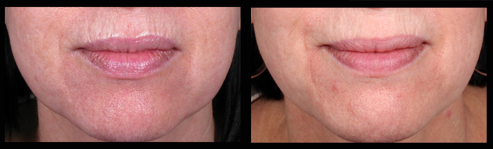 Patient before Venus Viva treatment for upper lip wrinkles and after. Treatment performed by Melissa Daniell (RN) 