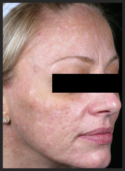 A patient with severe acne scarring 