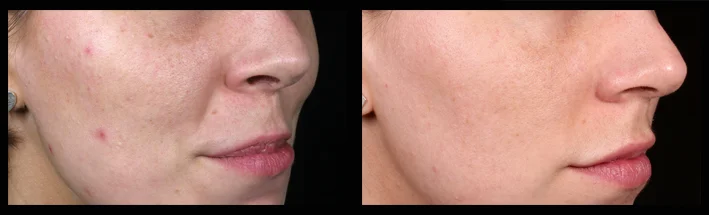 The patient was treated by Kristin Campbell (RN) for mild acne , pigmentation , enlarged pores and acne scarring using a combination of skin needling and light skin peels . 