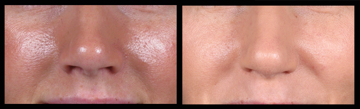 This photo shows a patient before and after having a series of Q-switched YAG laser treatments.