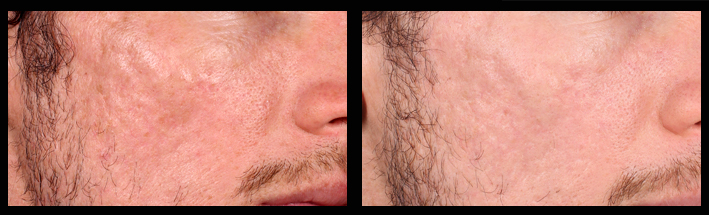 Venus Viva & Dermal Filler for acne scarring