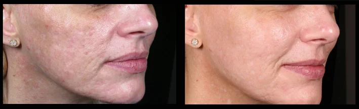 Dermal fillers combined with Venus Viva for acne scarring