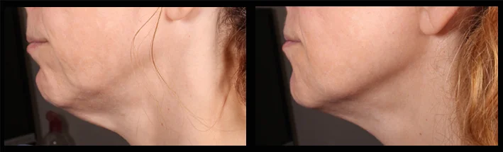 Dermal fillers for jawline, chin and turkey neck