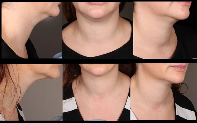 Neck tightening is performed using the Ultraformer III - The top row shows before Ultraformer III, the 2nd row shows 2 months after Ultraformer III - Ultraformer III benefits will peak between 6 and 9 months post treatment so we would expect continued improvement in this patient. Treatment performed by Katy Wallace RN. 