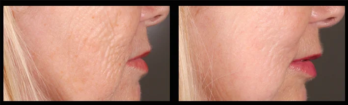 Deep lines on the cheek caused by sundamage and gravity are treated using PSR. Treatment performed by Assoc Prof Greg Goodman 