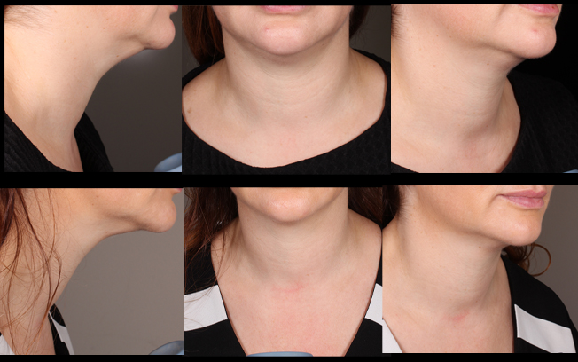 Ultraformer III used for skin tightening on the neck. N.B The top row shows before treatment, the bottom row shows 2 months post treatment. Ultraformer III benefits will peak between 6 and 9 months after treatment so we would expect to see continued improvement in this patient. Treatment performed by Katy Wallace RN.