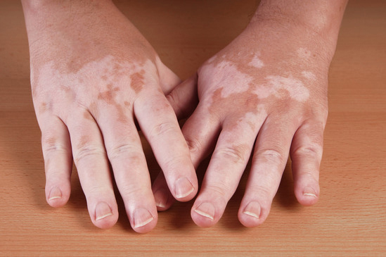 An example of colour loss in the skin caused by the disease Vitiligo 