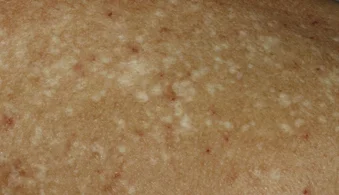A loss of pigment caused by acne scarring 