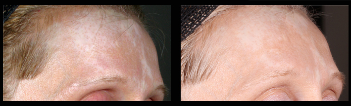ReCell® is used to re-introduce colour to the forehead. Treatment performed by Assoc Prof Greg Goodman.