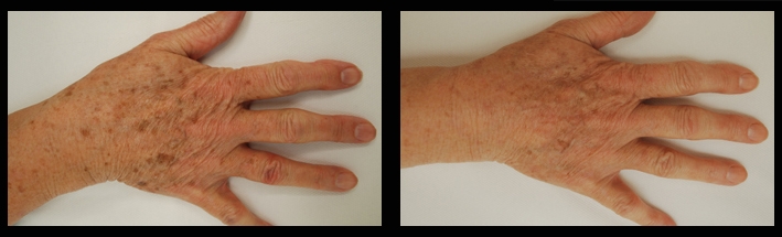 Vascular Laser for sunspots on hands